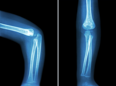 Film x-ray of child 's elbow ( normal child 's elbow ) ( Side and front view , Lateral and Anterior...