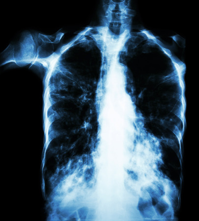 Pulmonary Tuberculosis  ( film chest x-ray :  interstitial infiltrate both lung due to Mycobacterium...