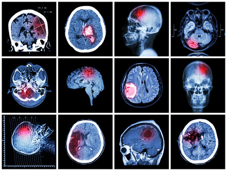 Collection of brain disease ( CT scan and MRI of brain : show cerebral infarct , intracerebral hemorrhage , brain tumor , basal ganglia hemorrhage ( status post craniotomy ) ) ( health care concept )