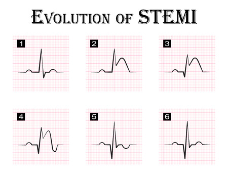 ECG of evolution ( step by step ) of STEMI ( ST elevation
