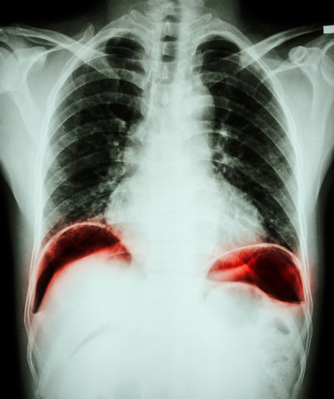 Peptic ulcer perforate . ( film chest x-ray show free air under dome of both diaphragm due to air leak from gastric ulcer or duodenal ulcer perforated ) ( surgical condition and concept )の写真素材