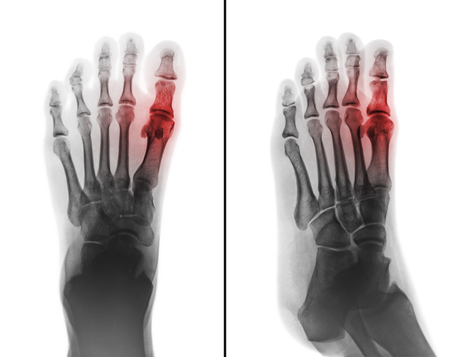 Gouty arthritis . film x-ray of human foot and arthritis at first metatarsophalangeal Joint . 2 position ( front and side view )の写真素材