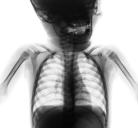 Film x-ray normal chest of baby . Upper half of body . Front view .の写真素材