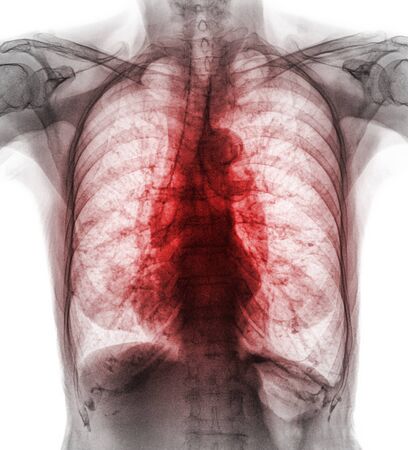 Pulmonary Tuberculosis . Film chest x-ray show interstitial infiltrate both lung due to Mycobacterium tuberculosis infection .の写真素材