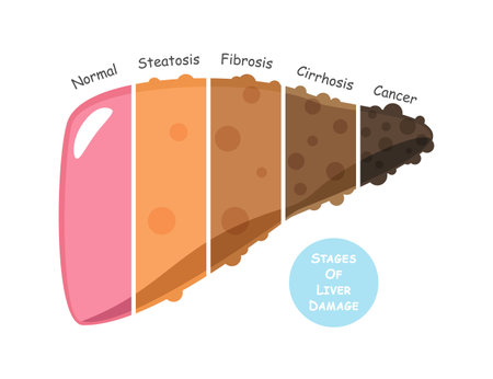 Stages of liver damage include steatosis or fatty liver, fibrosis, cirrhosis and cancer or hepatocellular carcinoma . Flat design . Vector .のイラスト素材