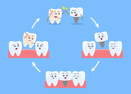 Dental implant procedure . Cartoon character illustration . Isolated on blue background . Vector .のイラスト素材