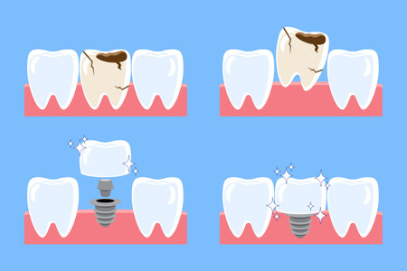 Dental implant procedure installation . Decayed tooth removed and replace by artificial tooth . Flat design cartoon illustration . Isolated on blue background . Vector .のイラスト素材