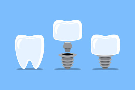 Dental implant procedure installation . Teeth and artificial tooth . Flat design cartoon illustration . Isolated on blue background . Vector .のイラスト素材