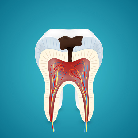 Teeth caries in cutaway Isolated on blue backgroundのイラスト素材