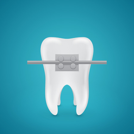 Isolated tooth with staples on blue backgroundのイラスト素材