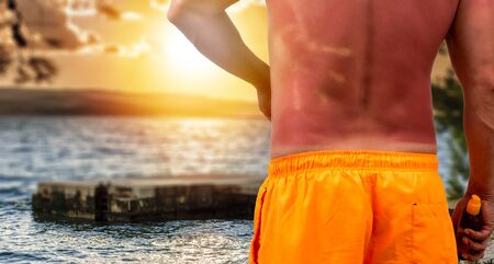 Man with sunburned skin and ocean beach with sunsetの写真素材
