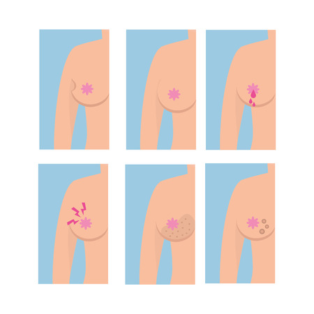 woman prevention breast cancer illness vector illustrationのイラスト素材
