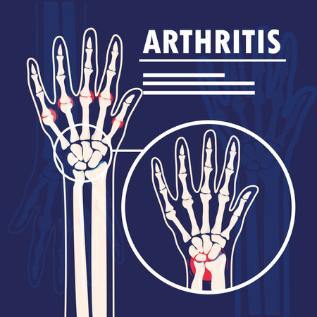 arthritis joints pain bones handsのイラスト素材