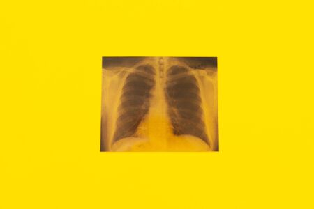x-ray picture on yellow background, concept, medicine, human lung disease