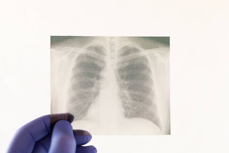 X-ray picture of a lung doctor holds a hand in a medical glove on a light background