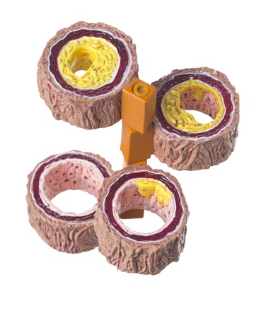 Isolated cross section of human artery with disordersの写真素材