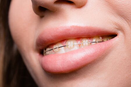 Close-up of a smiling girl teeth with braces. Dental clinic concept for advertising.
