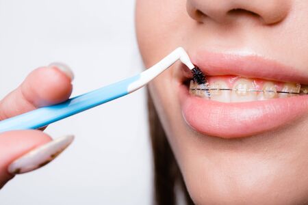 Close-up of a girls lips and teeth with a dental brush for cleaning the braces for an even bite
