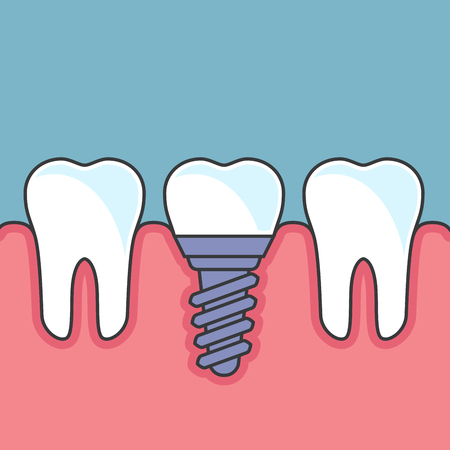 Row of teeth with dental implant - dental prostheticsのイラスト素材