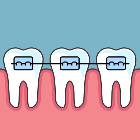 Teeth with dental braces - dental arrangeのイラスト素材