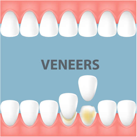 Teeth and smile makeover with dental ceramic veneers, row of foretooth before and after veneer cover, vectorのイラスト素材