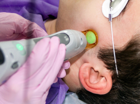 A medical specialist in pink gloves performs a laser hair removal procedure on the left side of the temporal area of a young manの写真素材