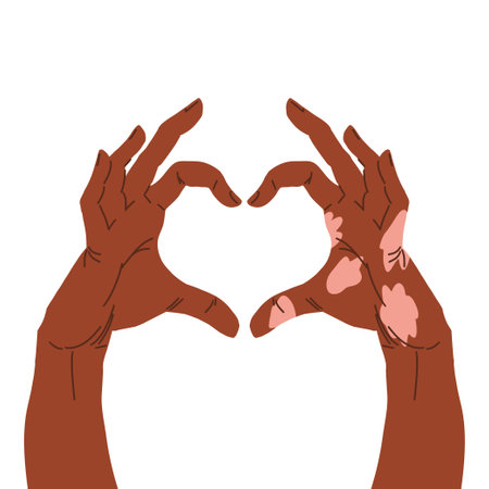 Two hands showing heart shape, one hand with vitiligo patch . Vector icon in hand drawn style isolated on white.のイラスト素材