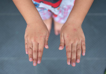 Rash on the hands of the Hand foot and mouth disease. Hand-foot-and-mouth disease is most commonly caused by a coxsackievirus and Enterovirus.の写真素材