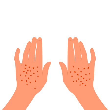 Red rash on the back of the female hands. Skin illness, allergy, inflammation. Isolated on white background. Flat style stock vector illustration.のイラスト素材