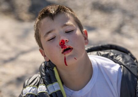 Boy ten years old with his nose bleeding