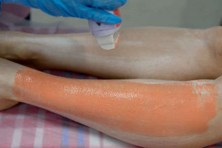 The stage of the epilation procedure.Removal of unwanted hair on the legs.の写真素材