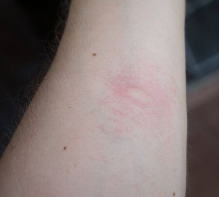 Closeup hand with insect bite