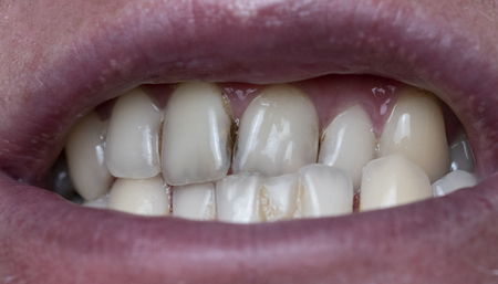 Closeup of dental plaque on man's teeth caused by coffee residualの写真素材