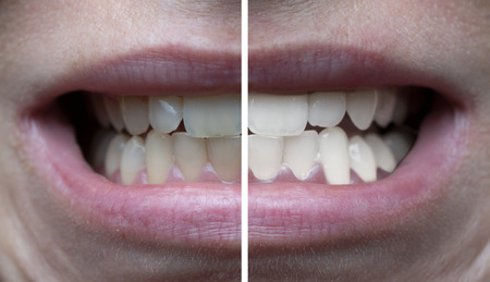 Closeup of woman's teeth before and after whiteningの写真素材
