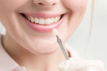 Close up of dentist using shade guide at woman's mouth to check veneer of teeth for bleachingの写真素材