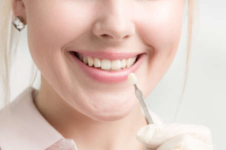Close up of dentist using shade guide at woman's mouth to check veneer of teeth for bleachingの写真素材