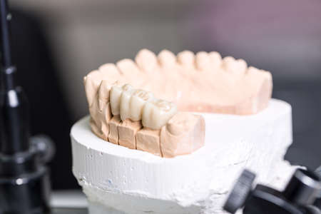a tooth implant on an articulator / prosthesis saddle in a dental laboratoryの写真素材