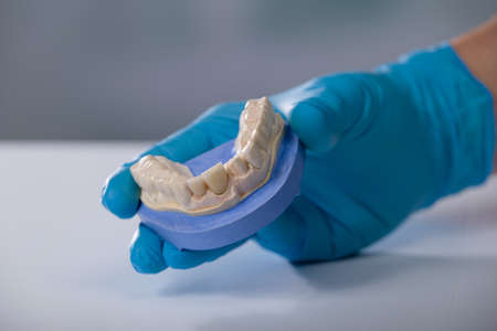 Dentist's / dental technician's hand in gloves is presenting a dental imprint with artificial...