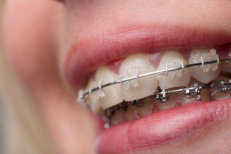close up of a female's mouth with a dental brace