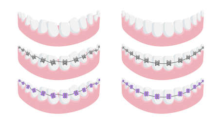 Lower jaw with healthy tooth and dental brace set. All type of metal, ceramic and invisible lingual orthodontic bracket system for teeth correction vector illustration isolated on white backgroundのイラスト素材