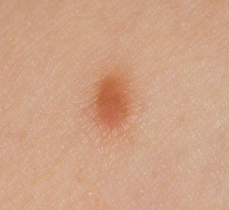 small scar on his leg