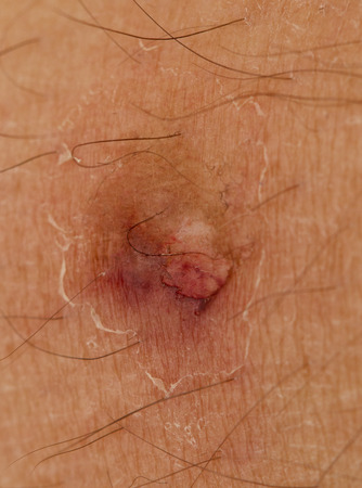 wound on his legの写真素材