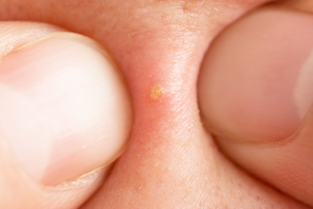 Acne skinの写真素材