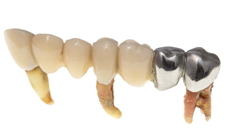 Patients extracted teeth on a white background