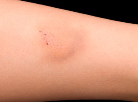 Bruise on leg