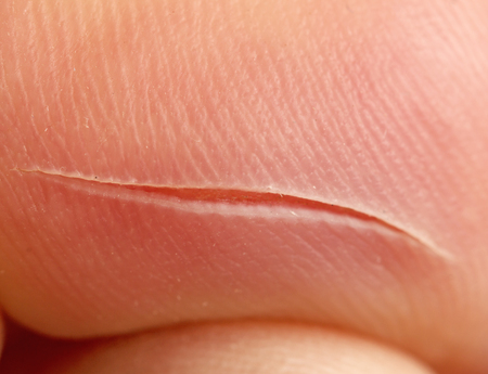 cut on the skinの写真素材