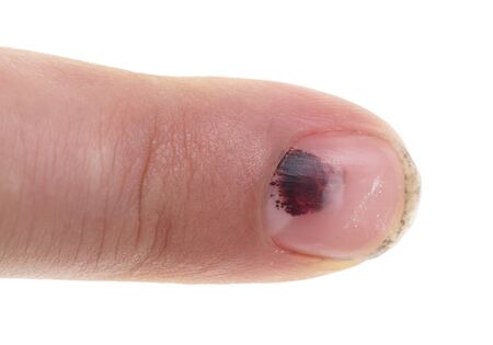 bruise on the fingerの写真素材