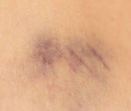bruise on the skin