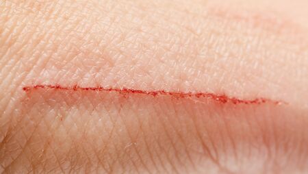 scratches on the skinの写真素材