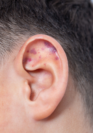 small bruises on the earの写真素材